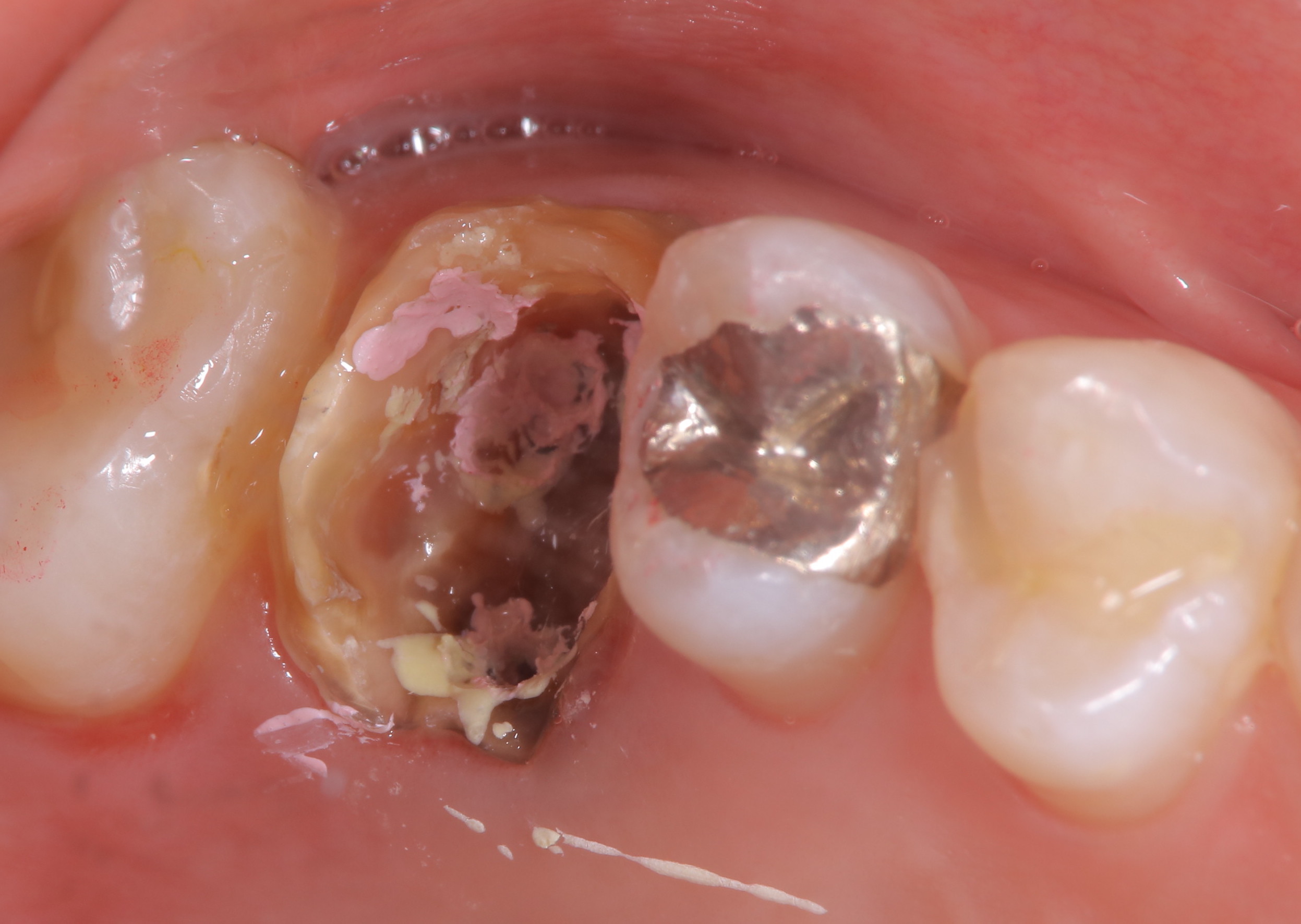 歯冠長増大術