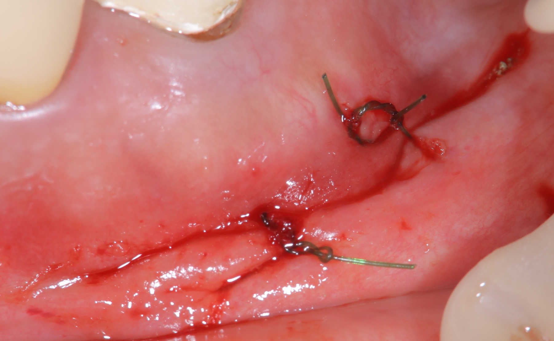 歯根端切除とMTAセメント
