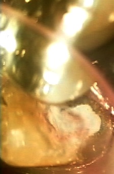 その歯髄残せます