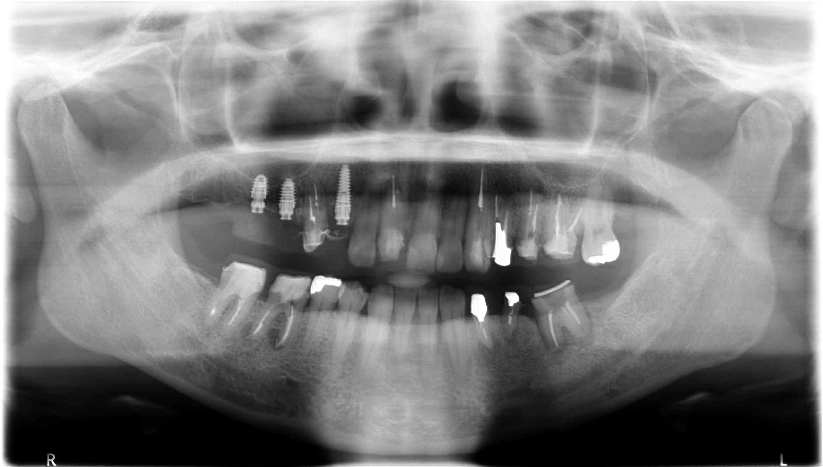 埋伏歯を移殖　part2