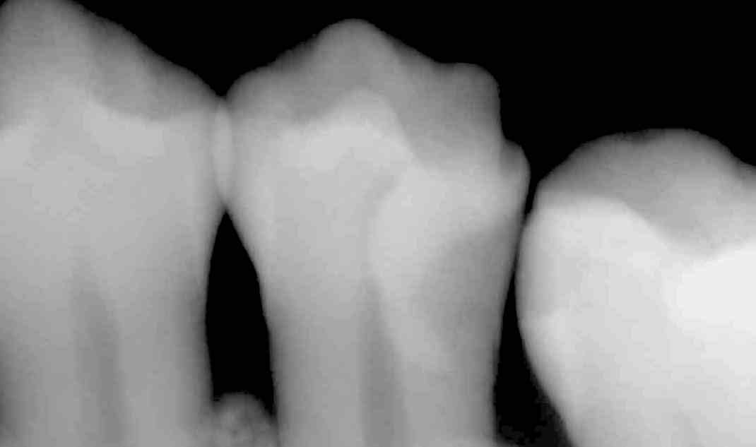 歯髄を残す　MTAセメント