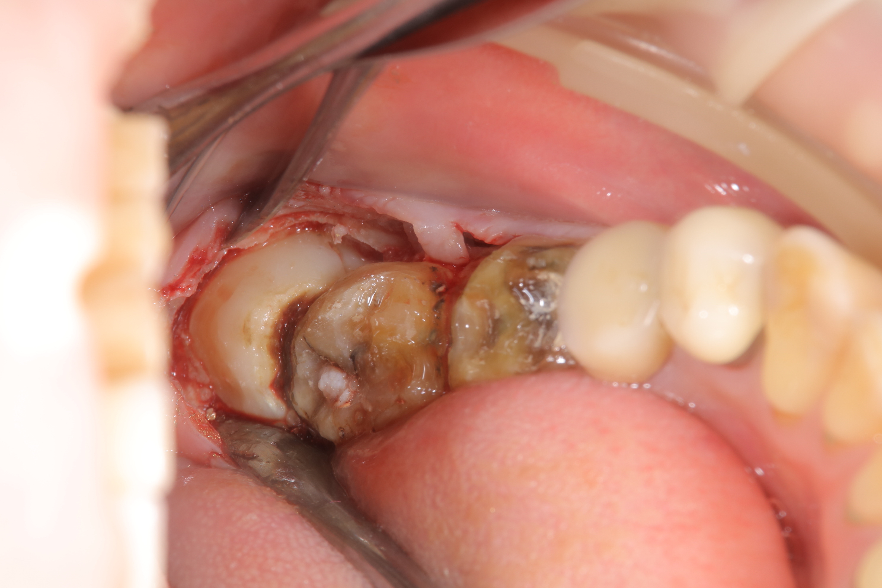 水平埋伏歯の抜歯