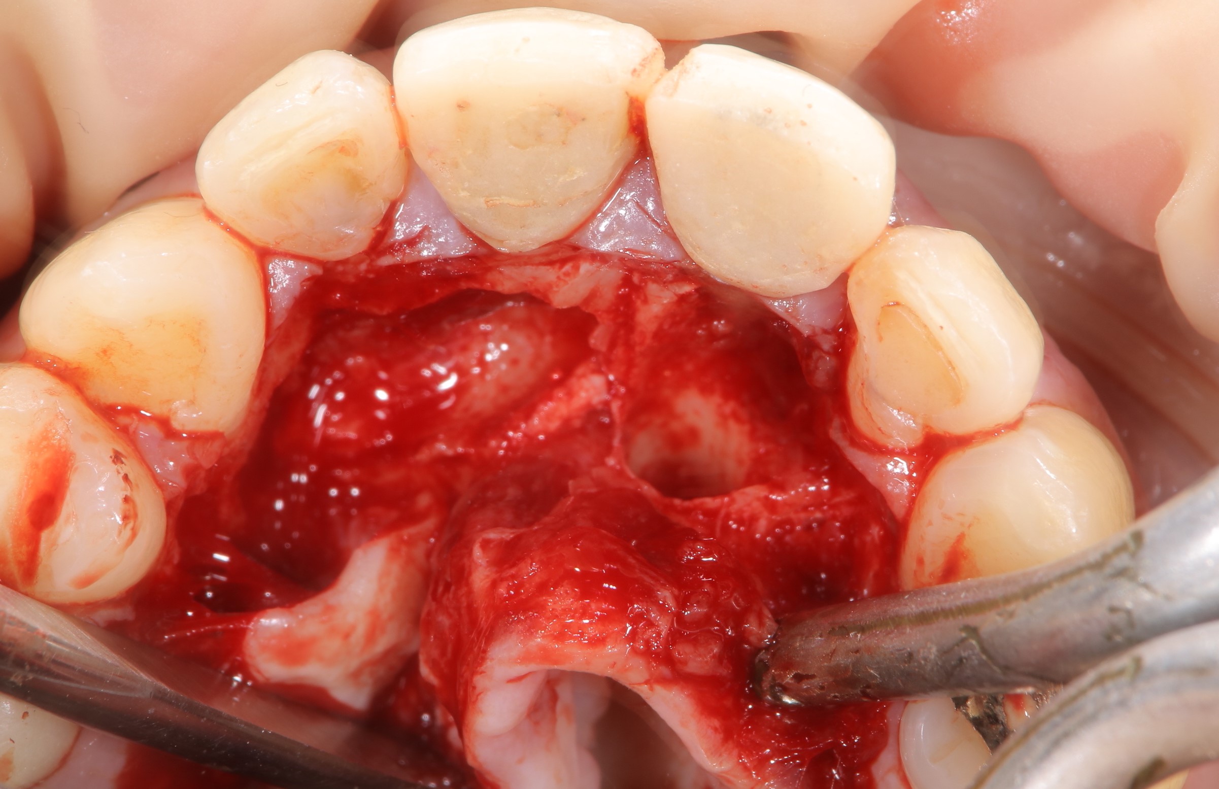サージボーンによる過剰歯の抜歯②