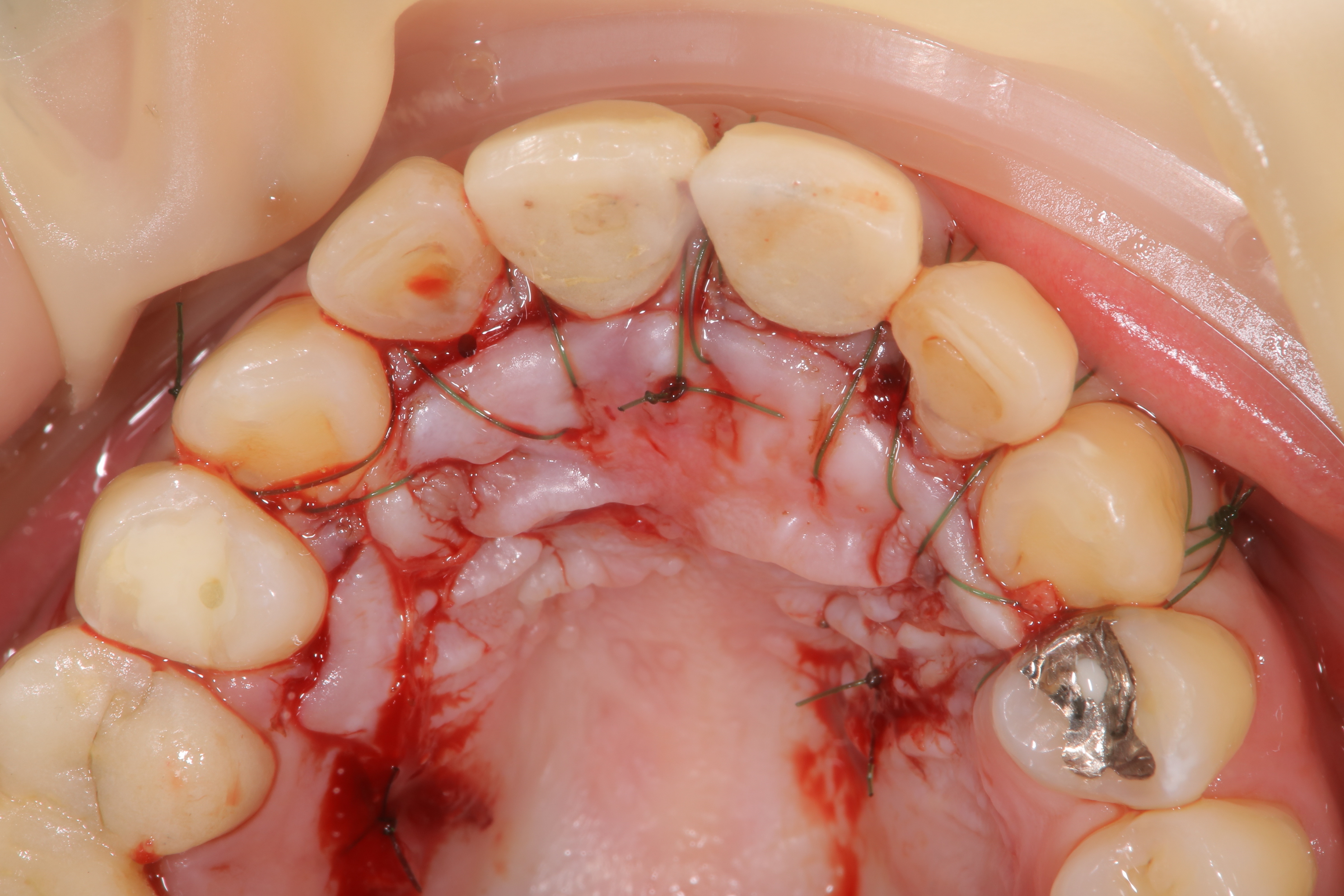 サージボーンによる過剰歯の抜歯②