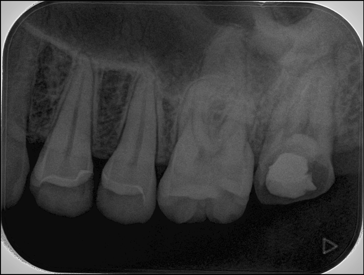 歯冠長延長術により歯牙保存①