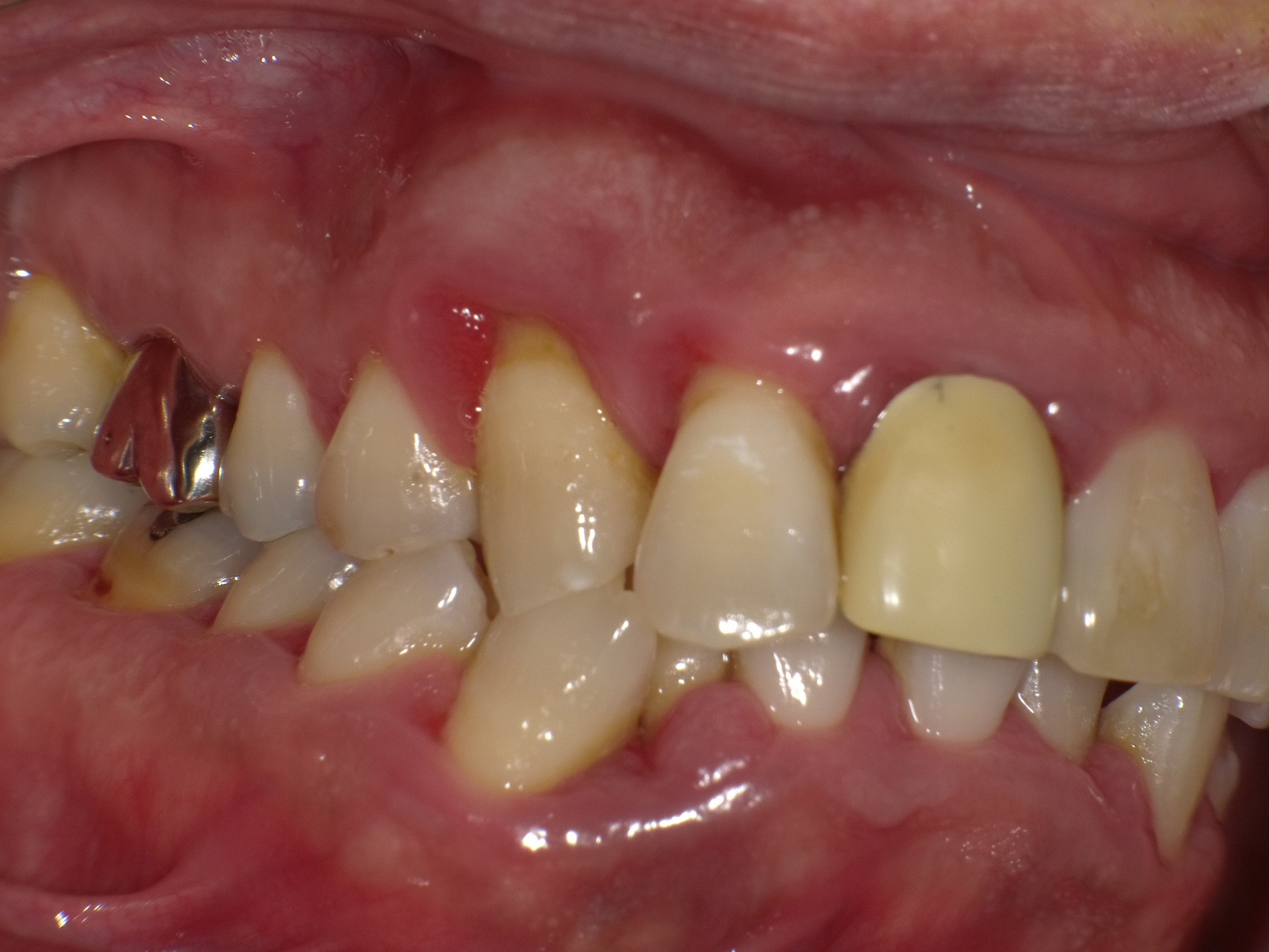 歯を抜かずに歯ブラシ1本で歯槽膿漏は直る