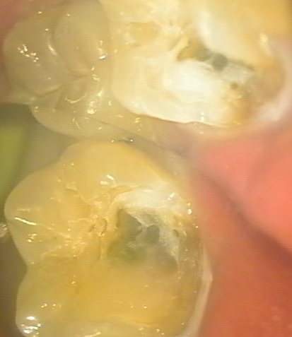 MTAを使用して歯髄保存