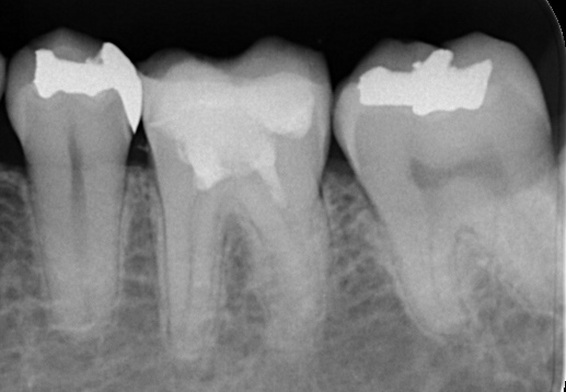 歯頚部断髄で歯髄（MTA)