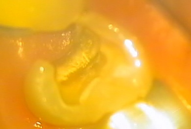 MTAを使い歯髄保存