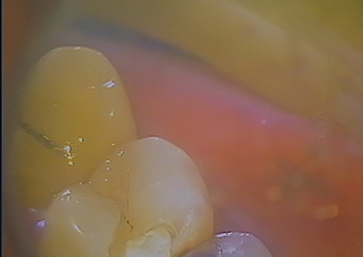 MTAを使用して歯髄保存