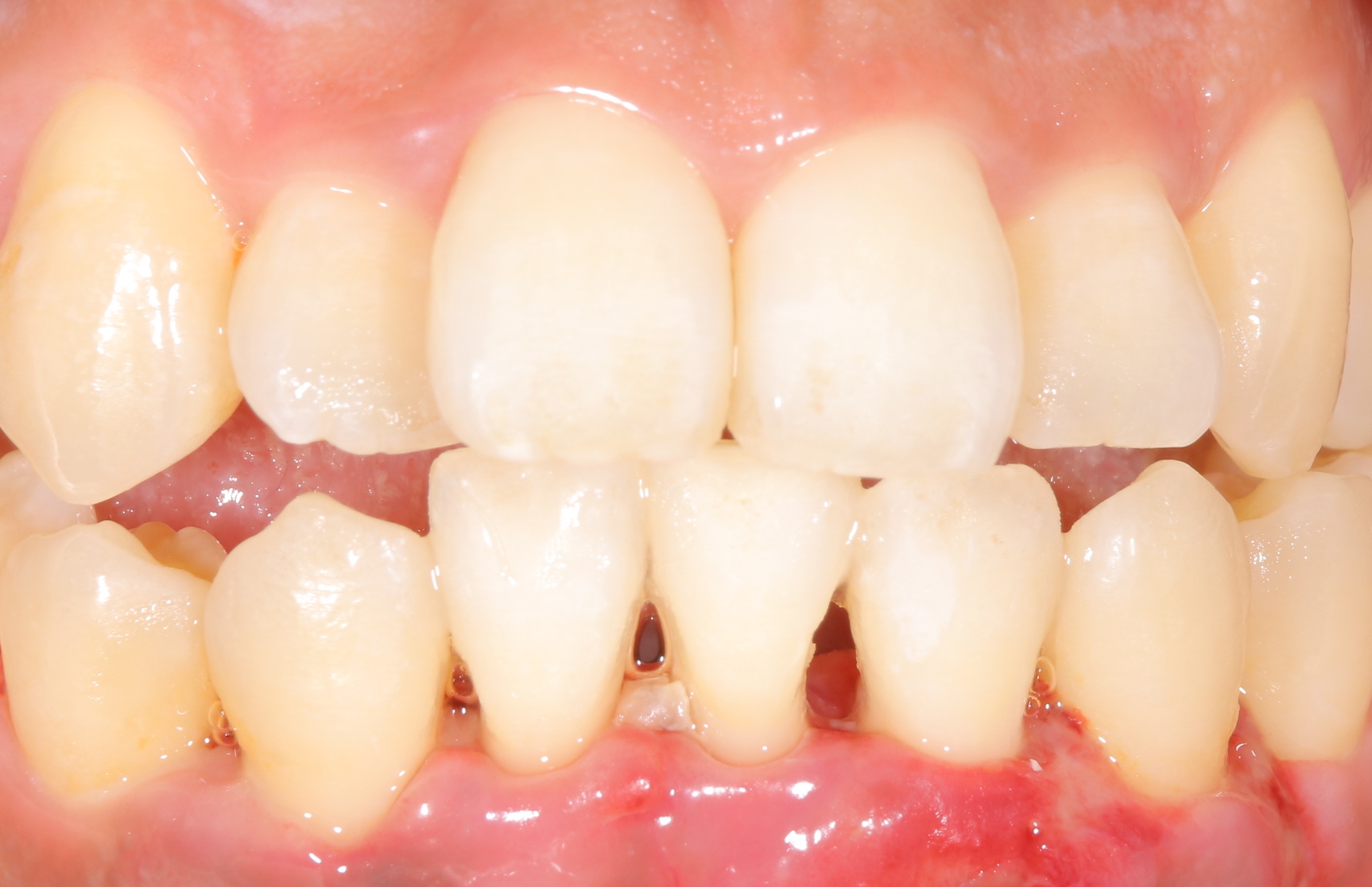 歯周組織再生療法リグロスを用いて