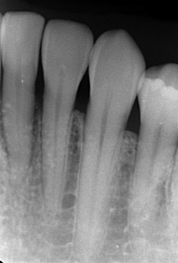 歯周組織再生療法リグロスを用いて