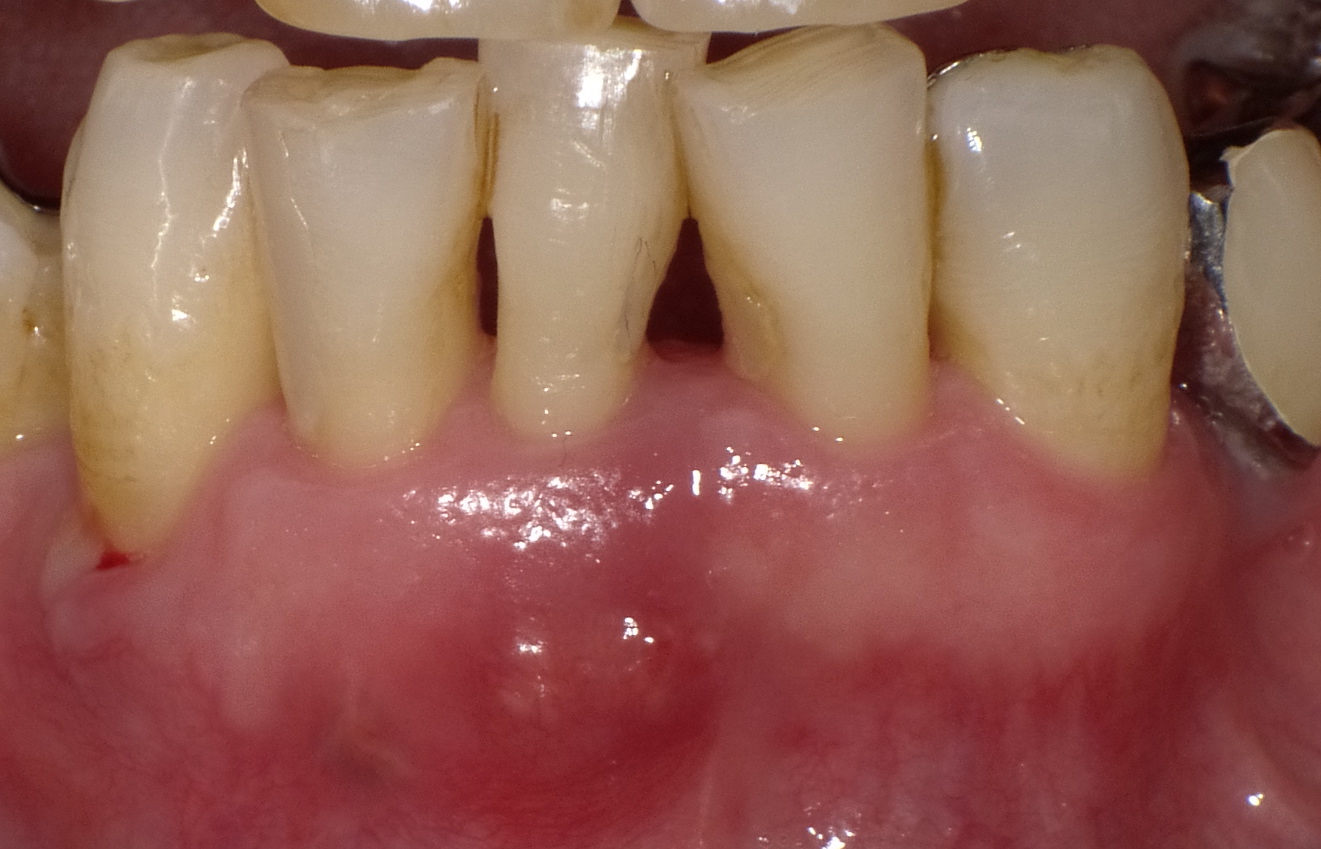 歯肉剥離ソウハ術で抜歯せずに歯を残す