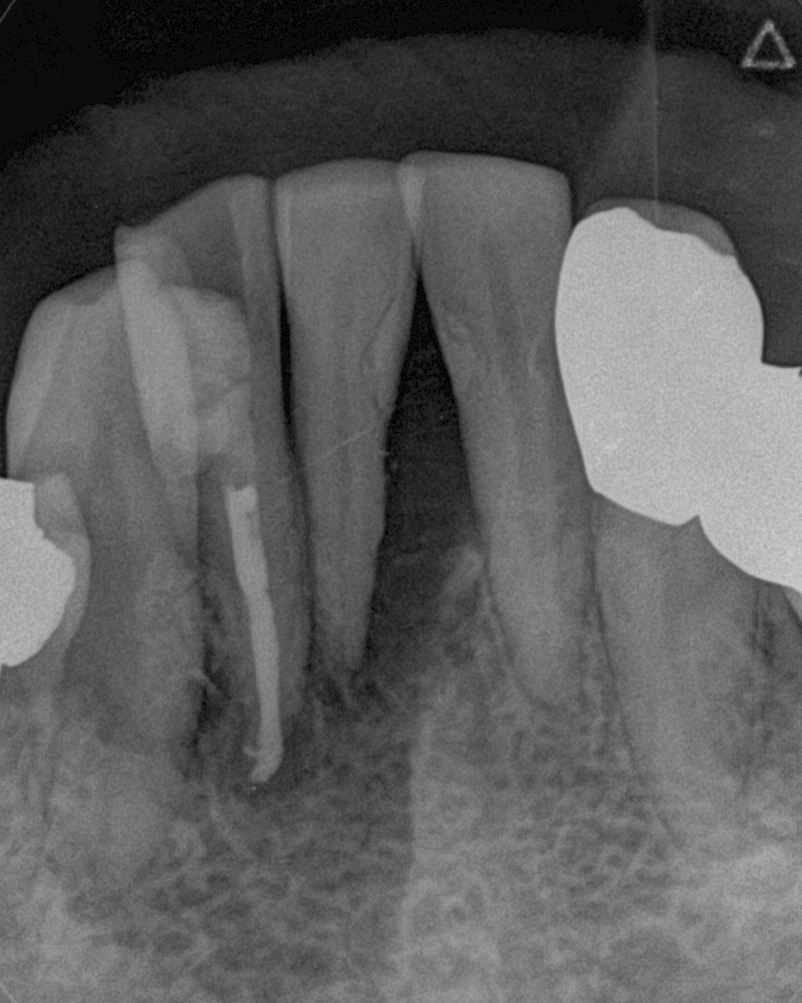 ②歯周再生療法（リグロスによる）