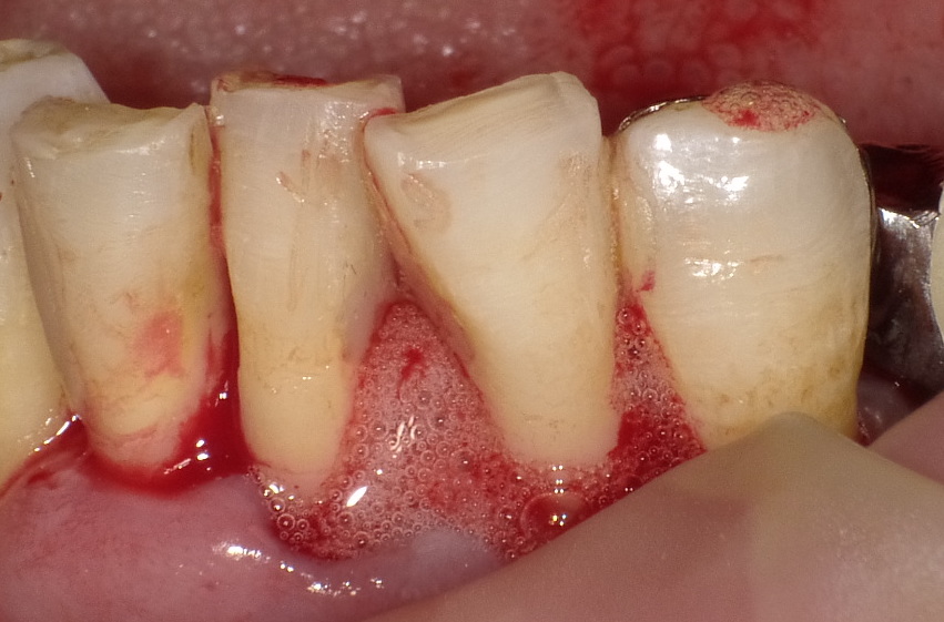 ②歯周再生療法（リグロスによる）