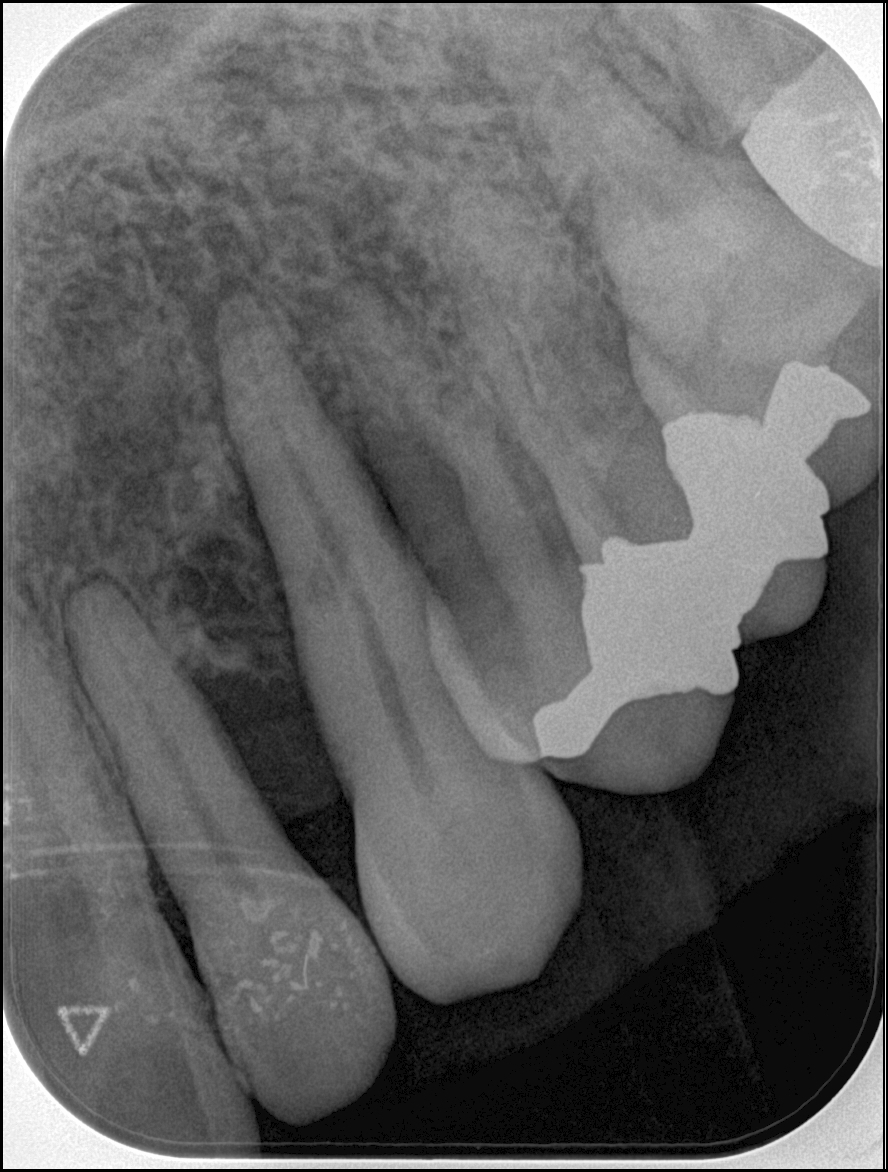 ③歯周再生療法（リグロスによる）