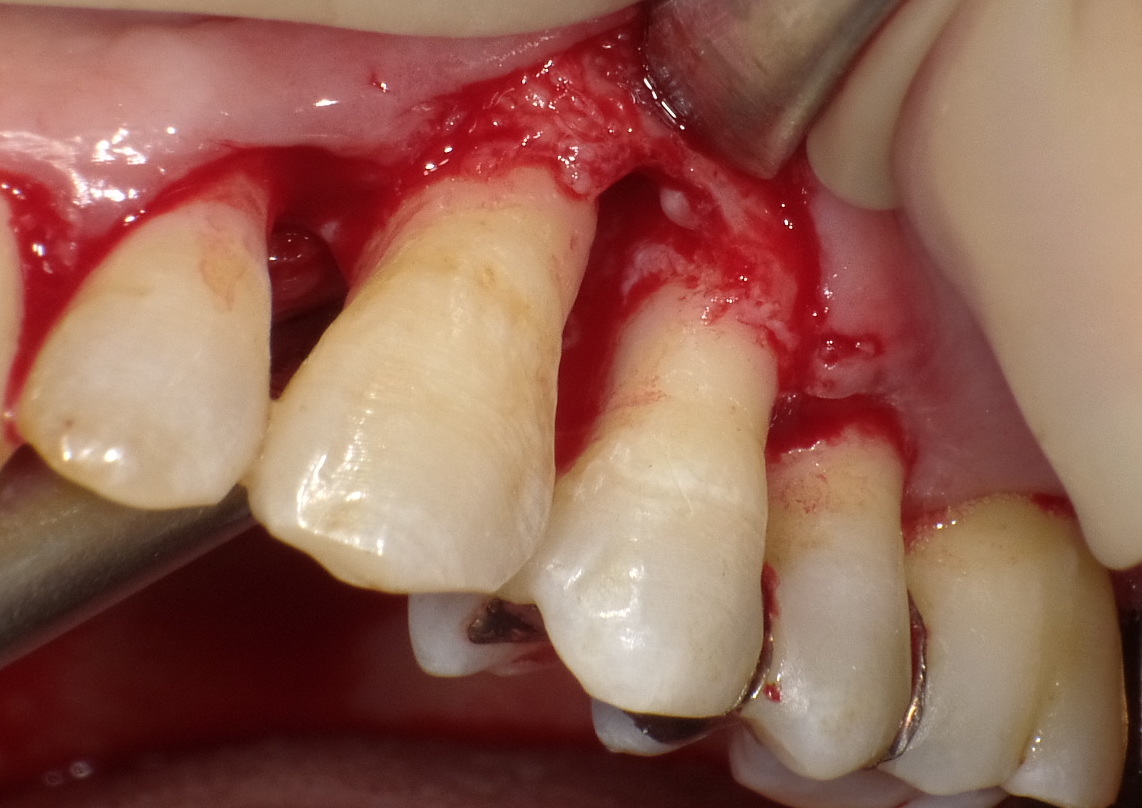 ③歯周再生療法（リグロスによる）