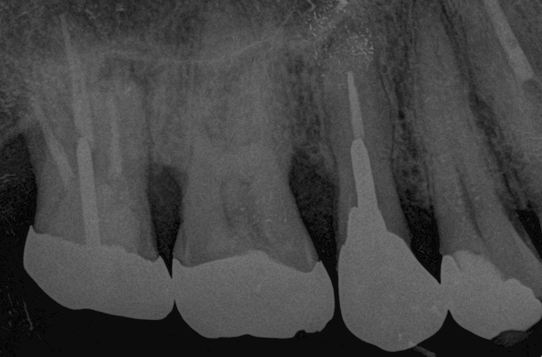 ④歯周再生療法（リグロスによる）