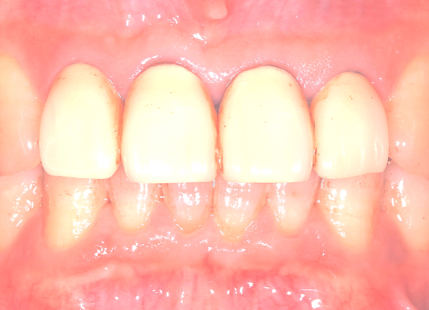金属アレルギーの心配の無い天然歯のようなジルコニア冠
