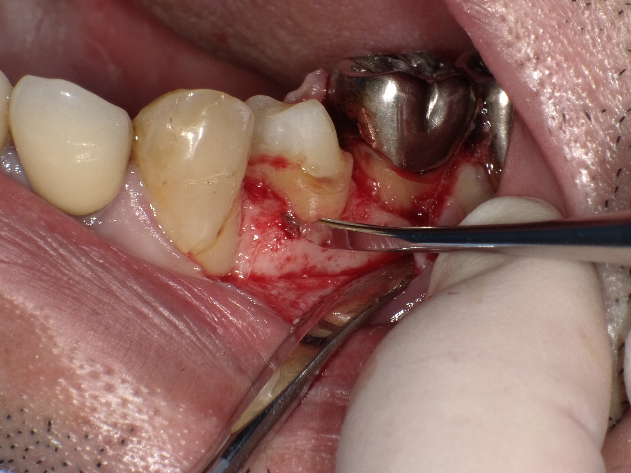 右上５歯冠長増大術
