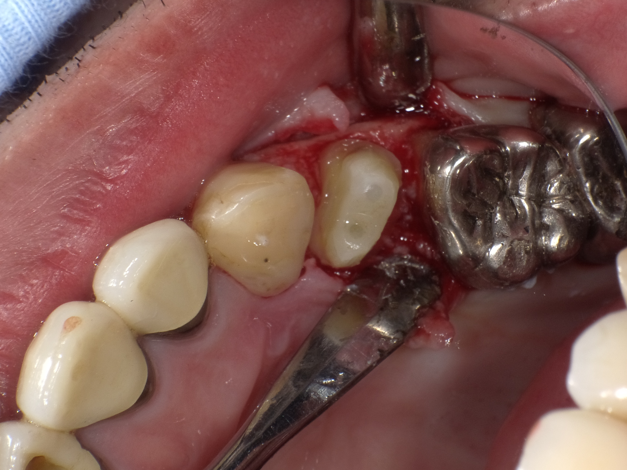 右上５歯冠長増大術