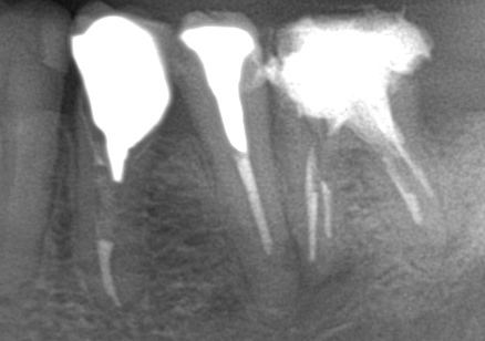 左下５歯冠長増大術