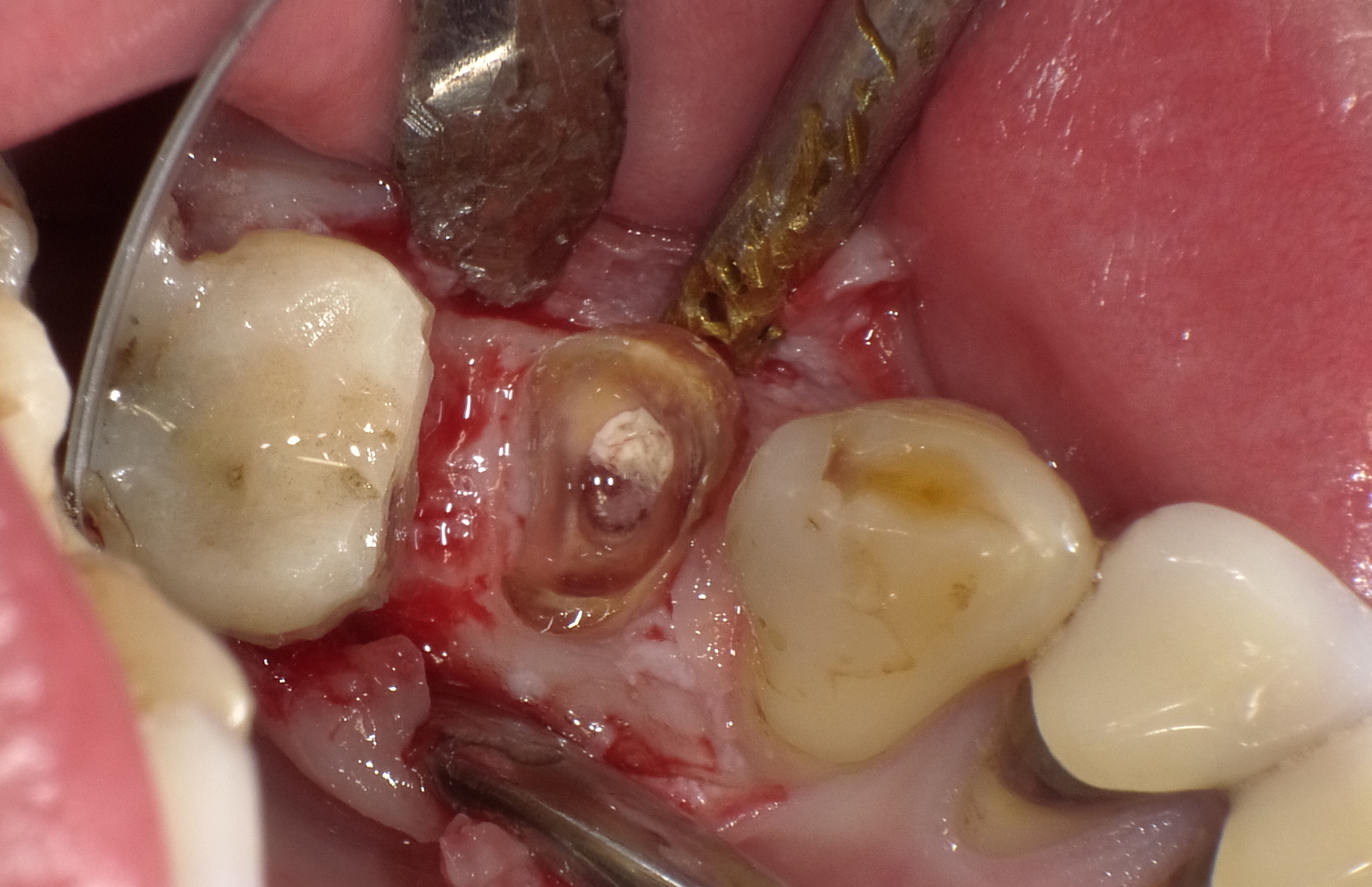 左下５歯冠長増大術