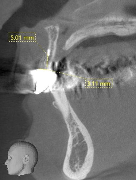歯槽提骨内異物除去し歯槽提増大