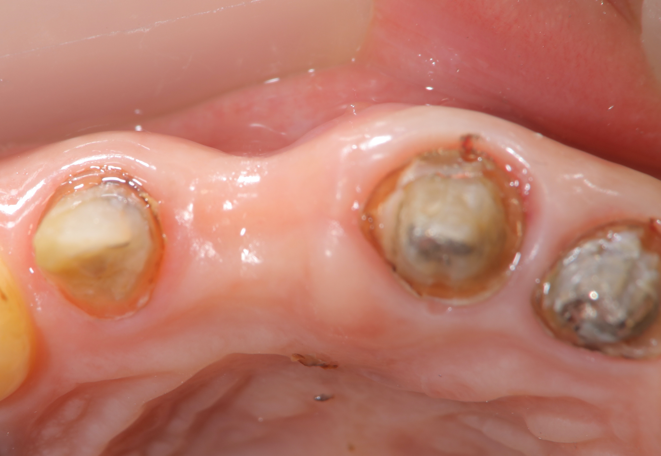 歯槽提骨内異物除去し歯槽提増大