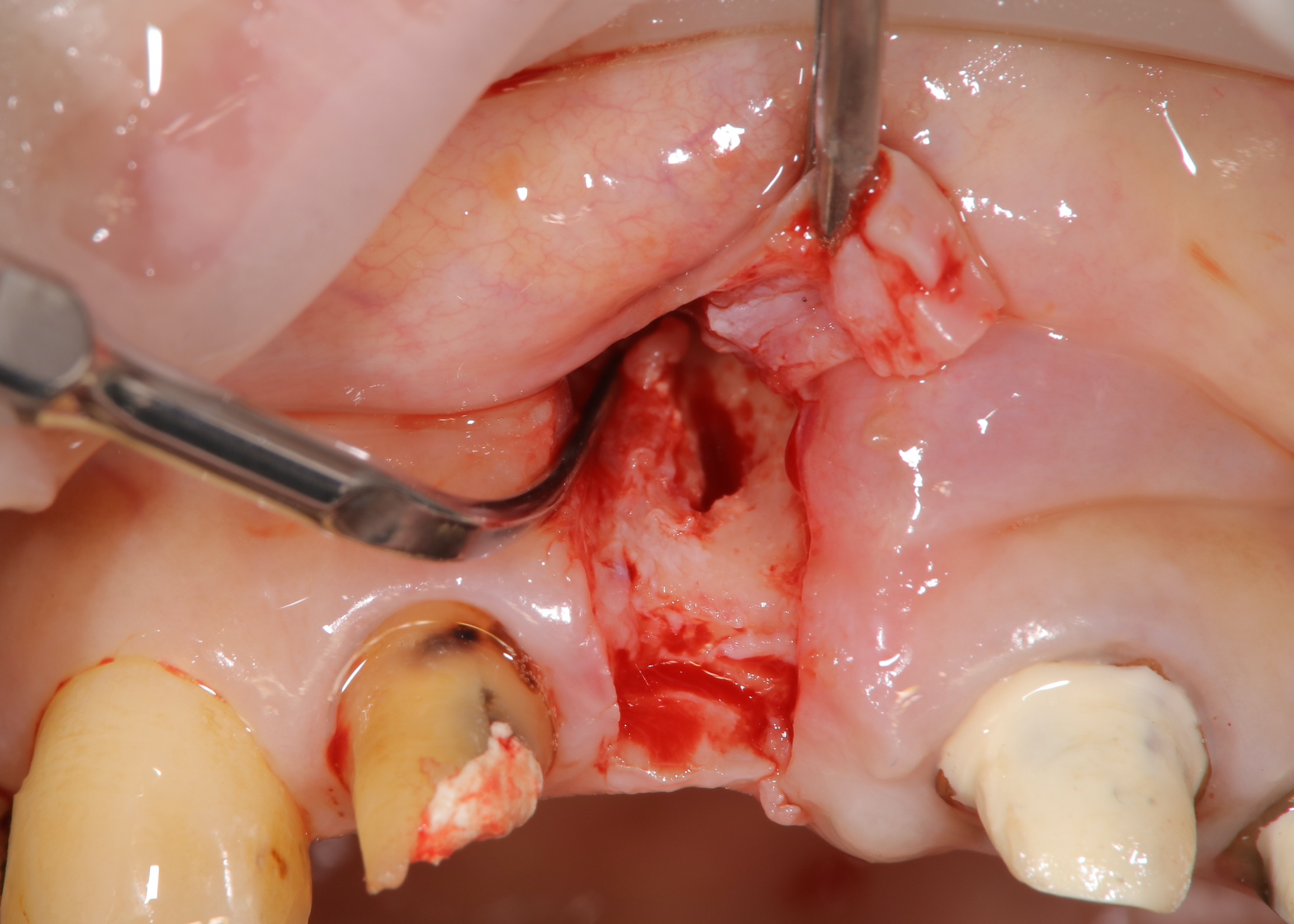 歯槽提骨内異物除去し歯槽提増大