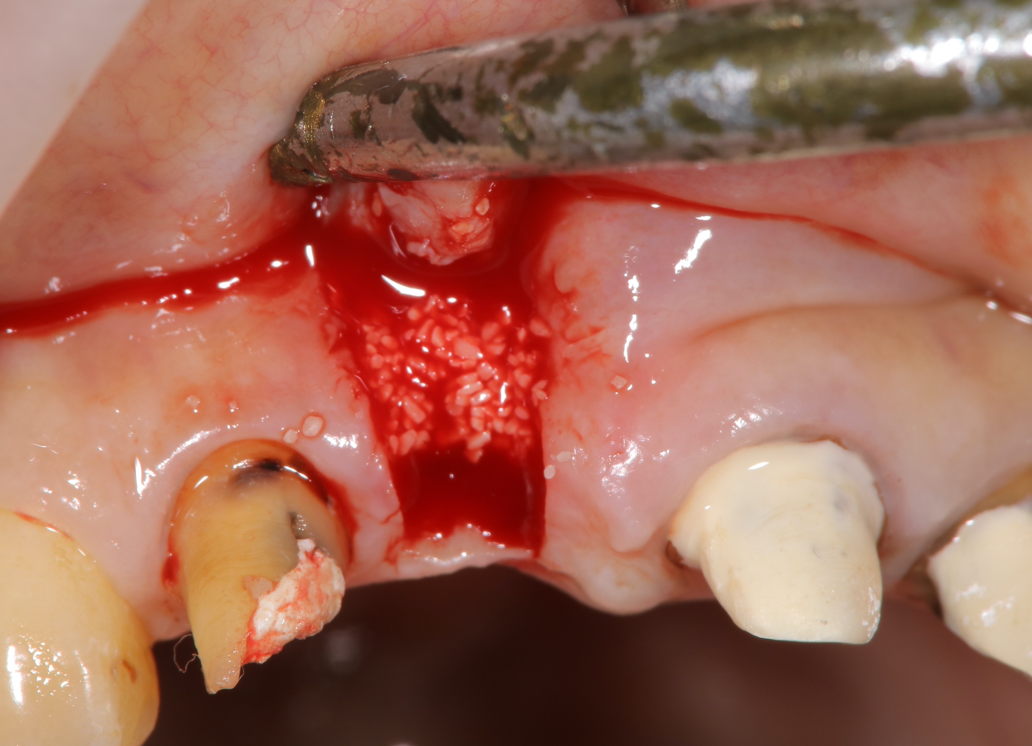 歯槽提骨内異物除去し歯槽提増大②