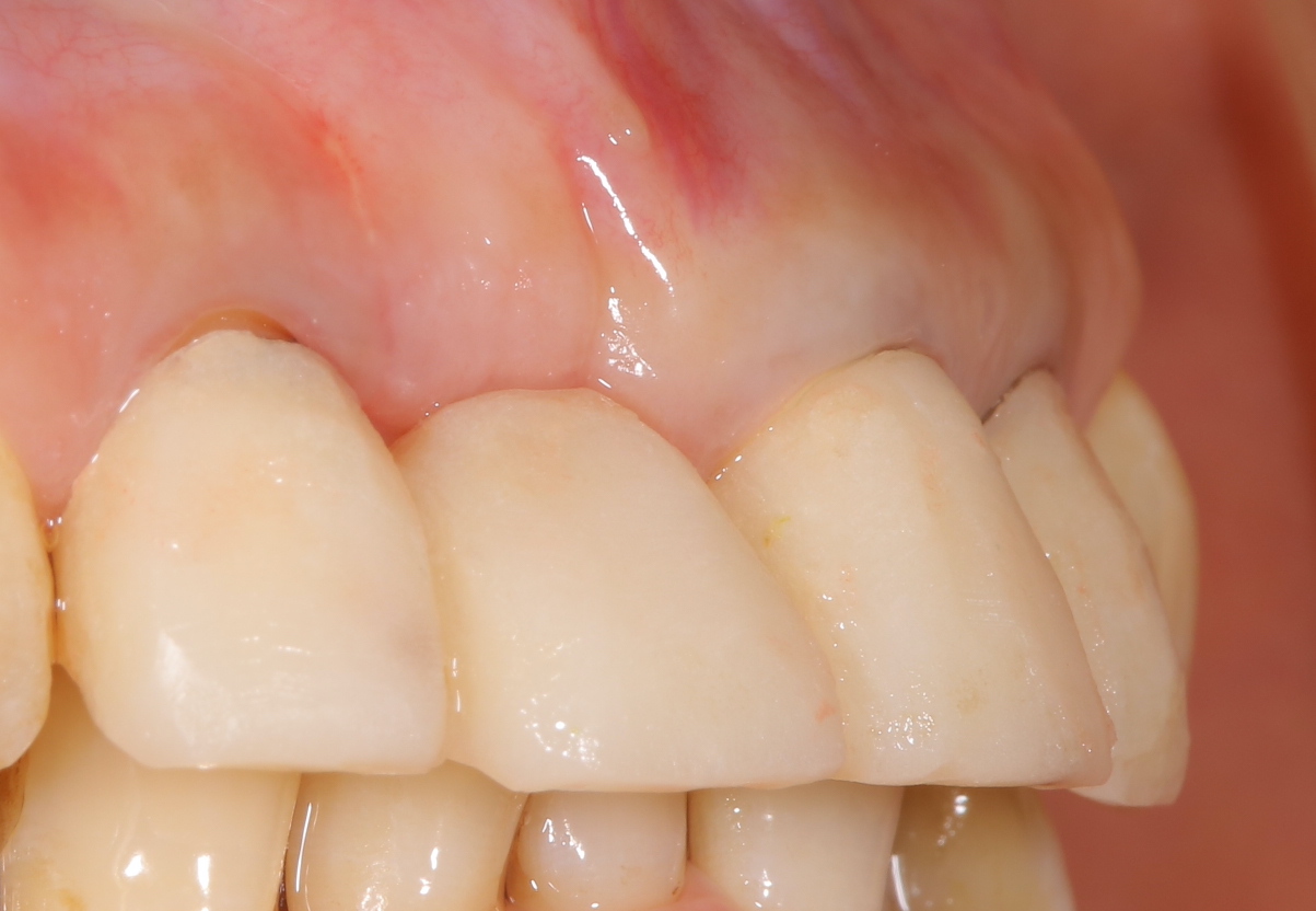 歯槽提骨内異物除去し歯槽提増大②