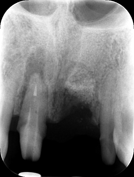 歯冠長増大術２