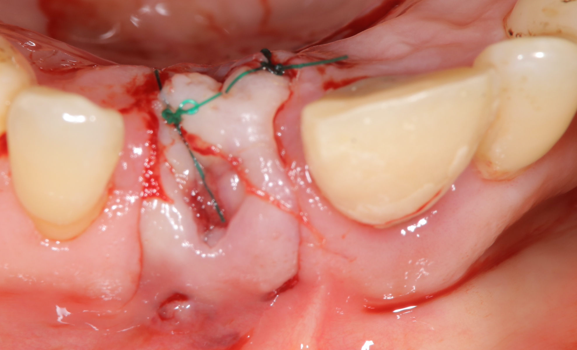歯冠長増大術２