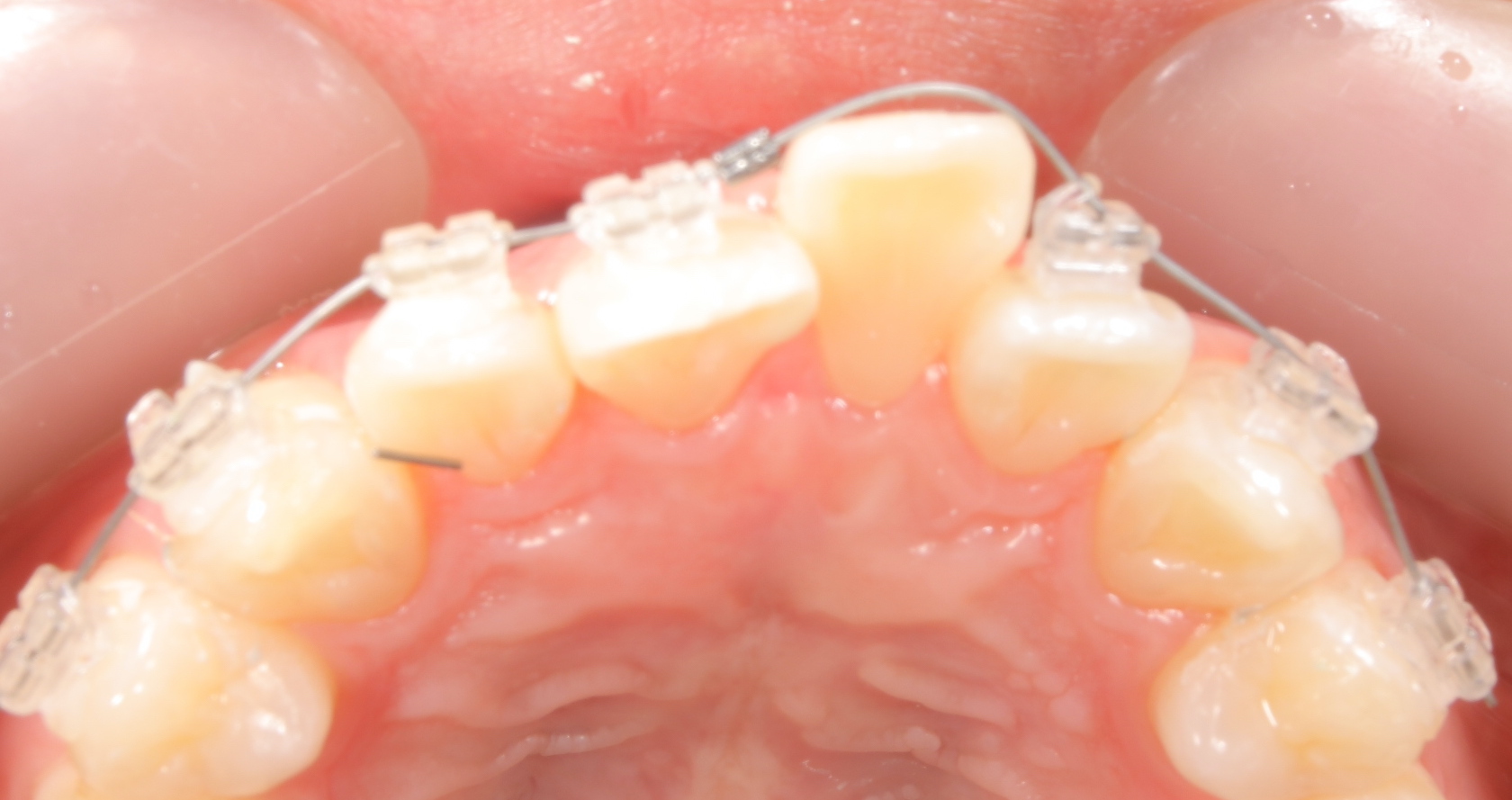 歯列不正を5ヶ月で治すゴムメタルワイヤー