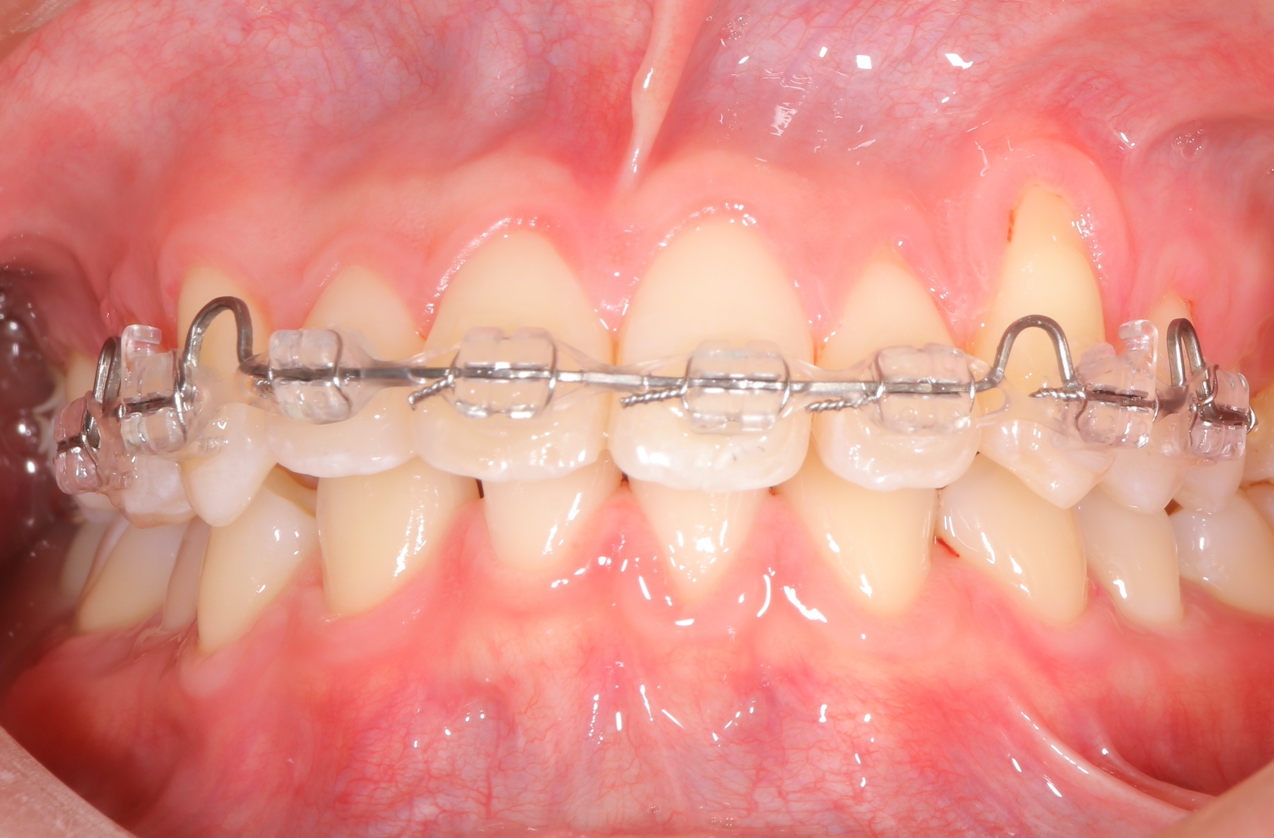 歯列不正を5ヶ月で治すゴムメタルワイヤー