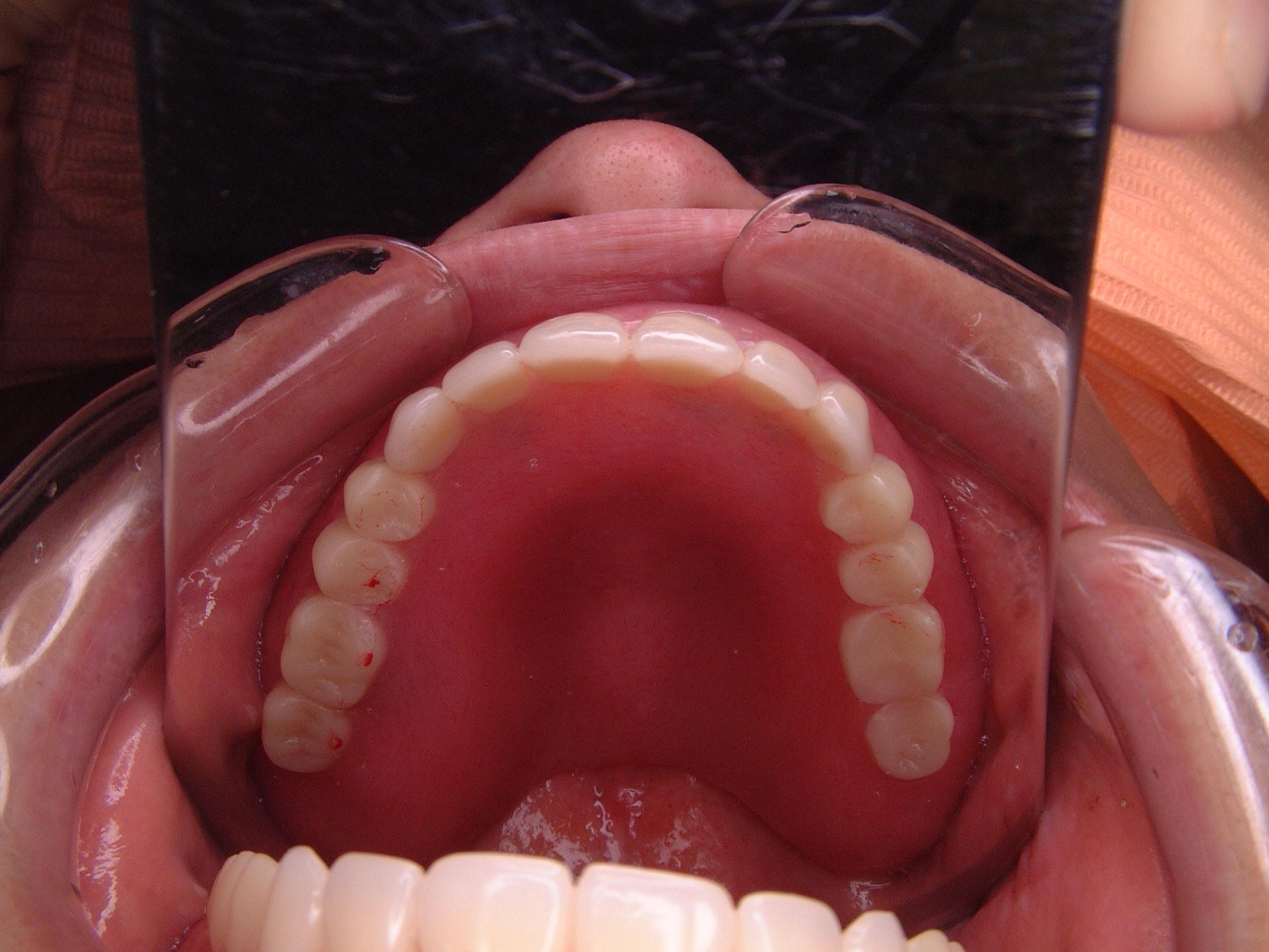 総義歯からｲﾝﾌﾟﾗﾝﾄにより固定性へ