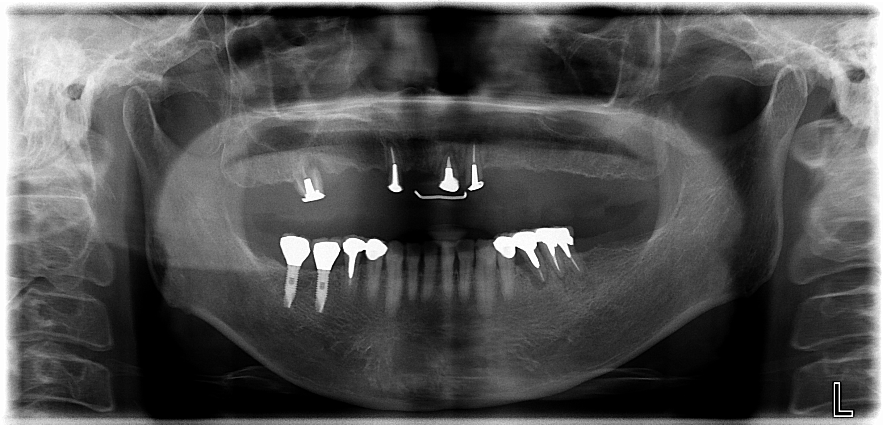 総義歯からｲﾝﾌﾟﾗﾝﾄにより固定性へ