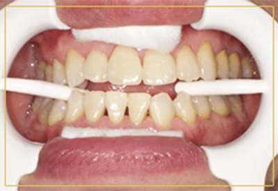 【1】 前歯を始め歯列がしっかり見えるように、お口を開けたまま固定します