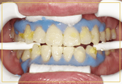 【3】 歯の表面に高濃度のホワイトニングジェルを塗ります